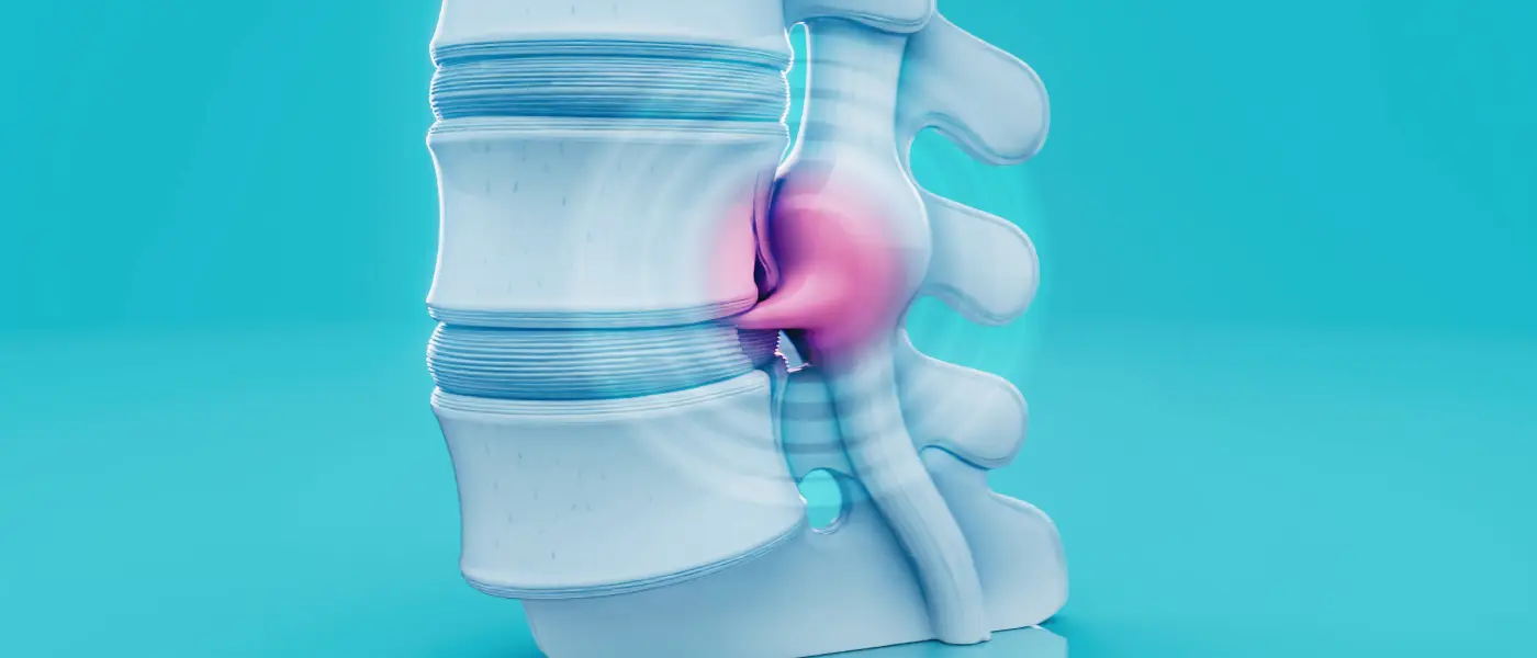 Se puede aliviar el dolor de una hernia discal con fisioterapia